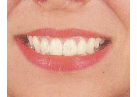 whiteningteeth